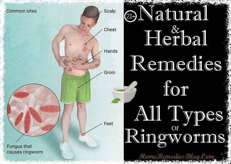 Top 7 Essential Oils For Ringworm Essential Oils For Ringworm