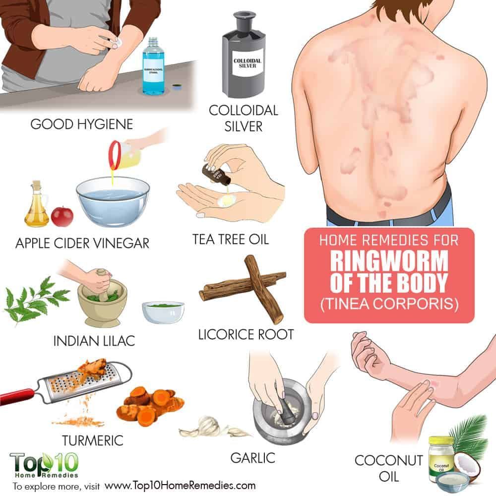 29 Fast Home Remedies To Get Rid Of Ringworm Get Rid Of Ringworm